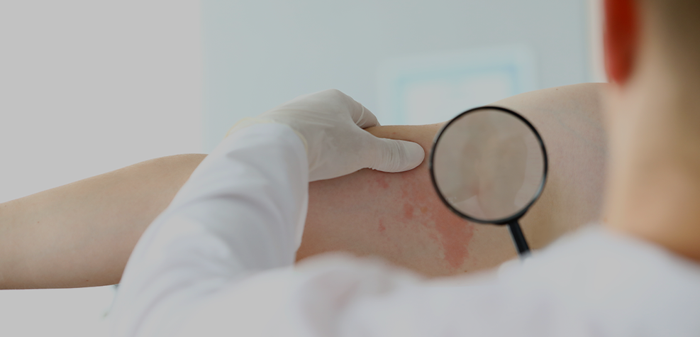 Características clínicas e histológicas durante la urticaria crónica con infiltrado dérmico neutrofílico: propuesta de una puntuación diagnóstica